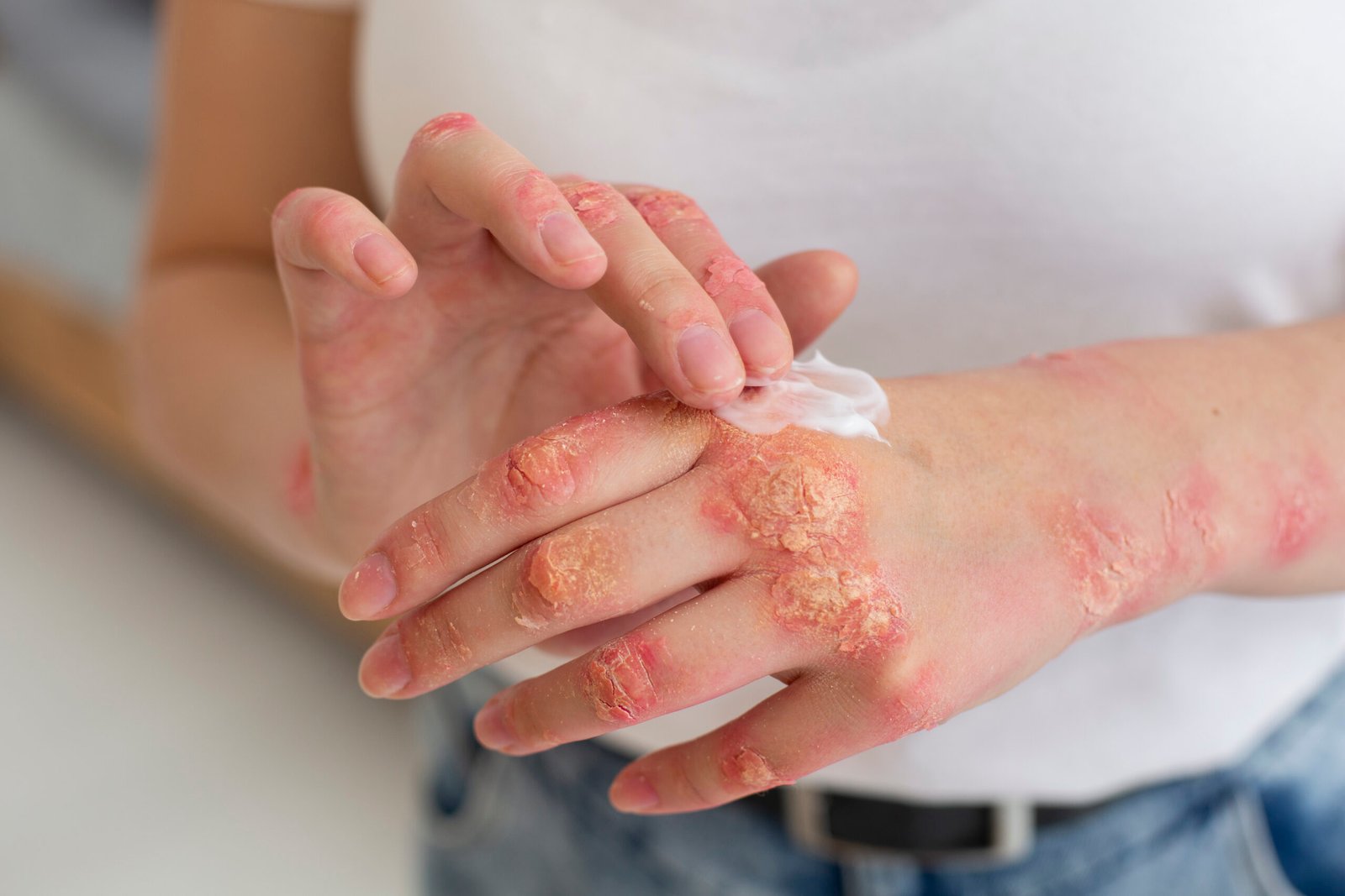Psoriasis Relief with Cannabis in Oklahoma